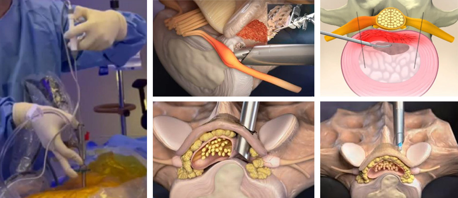Radio Frequency and Plasma Surgery System PRF-300