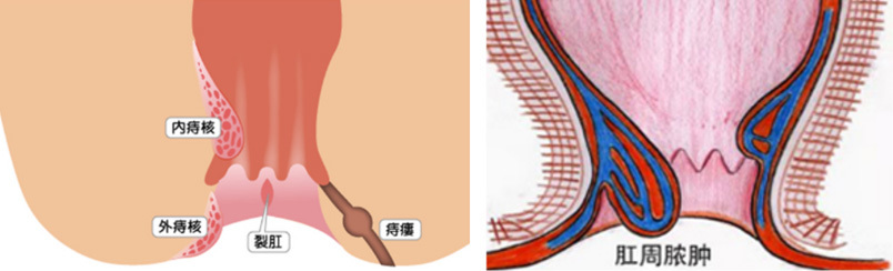 Disposable surgical electrode
