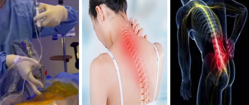 Disposable bipolar high-frequency surgical electrode