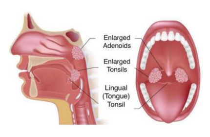 Plasma Surgery System P-300