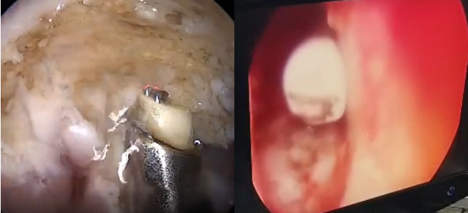Radio Frequency and Plasma Surgery System PRF-300