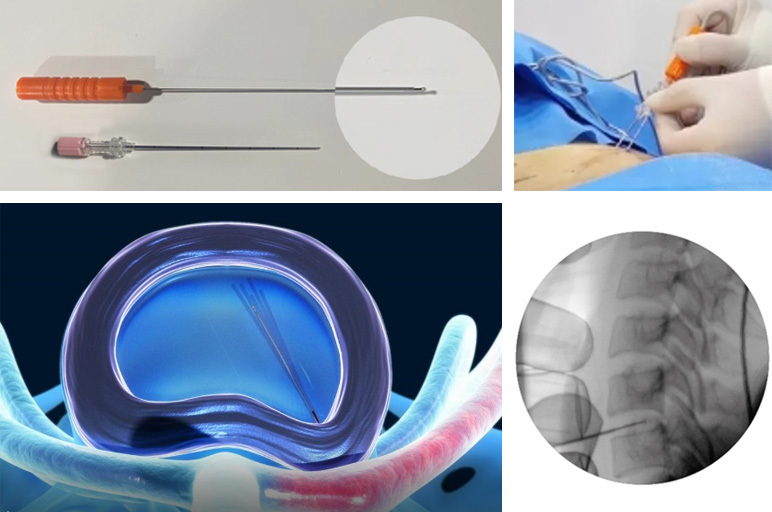 Radio Frequency and Plasma Surgery System PRF-300