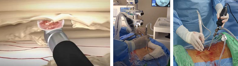 Radio Frequency and Plasma Surgery System PRF-300